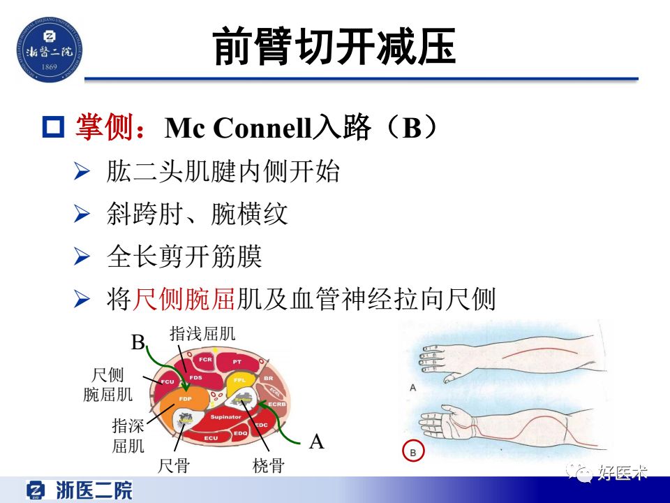 骨筋膜室综合征的诊治策略