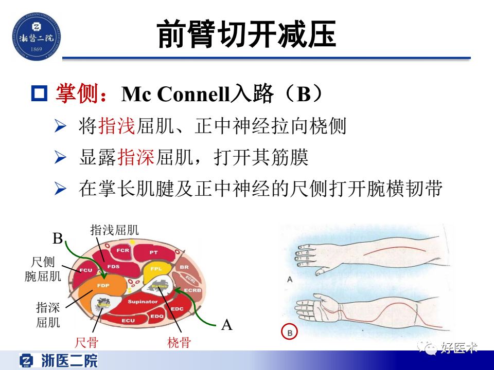 骨筋膜室综合征的诊治策略