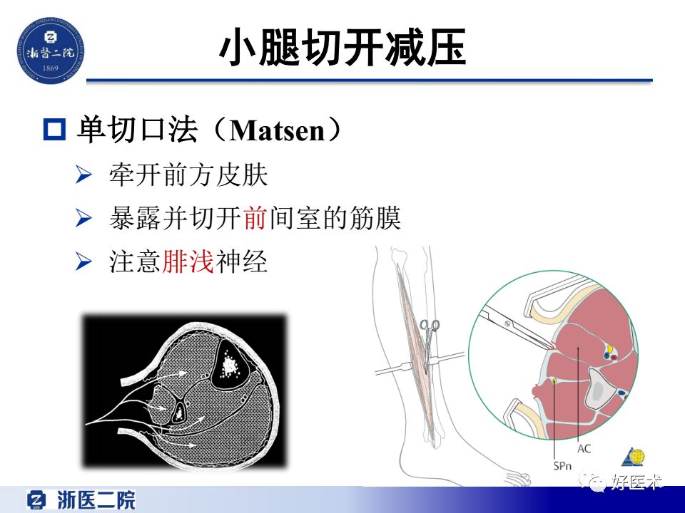 骨筋膜室综合征的诊治策略