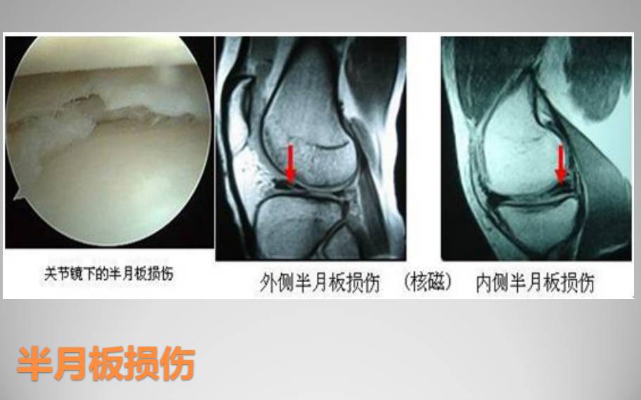 膝关节损伤MR诊断的内容及技巧