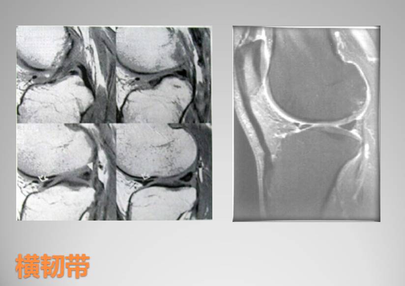 膝关节损伤MR诊断的内容及技巧