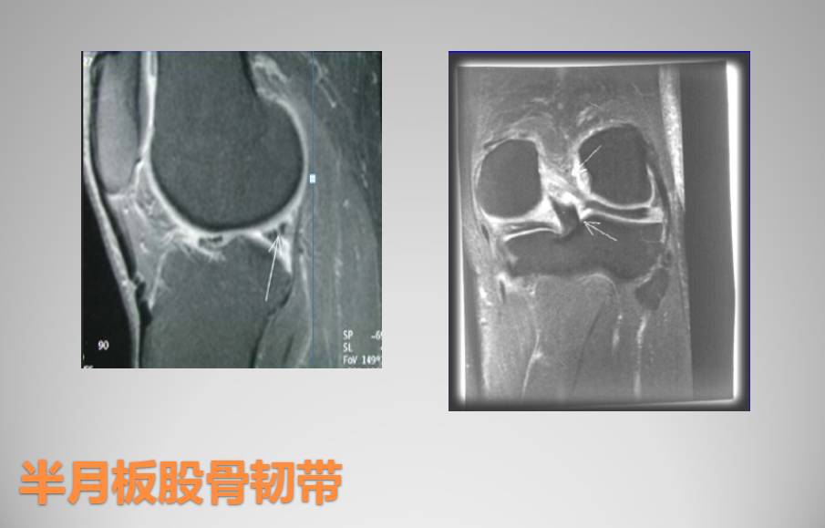 膝关节损伤MR诊断的内容及技巧