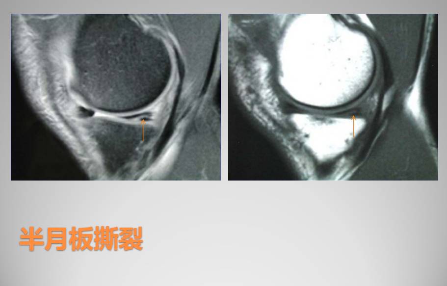 膝关节损伤MR诊断的内容及技巧