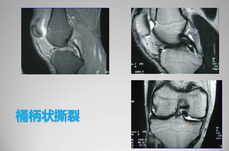 膝关节损伤MR诊断的内容及技巧