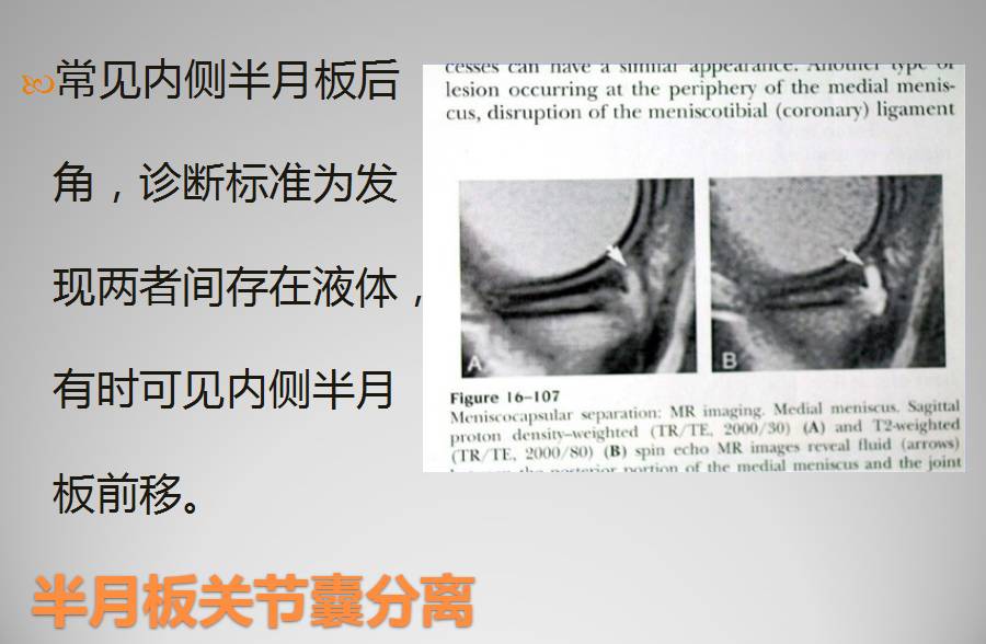 膝关节损伤MR诊断的内容及技巧