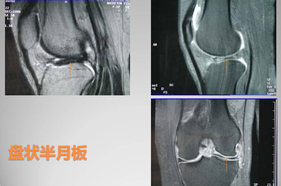 膝关节损伤MR诊断的内容及技巧