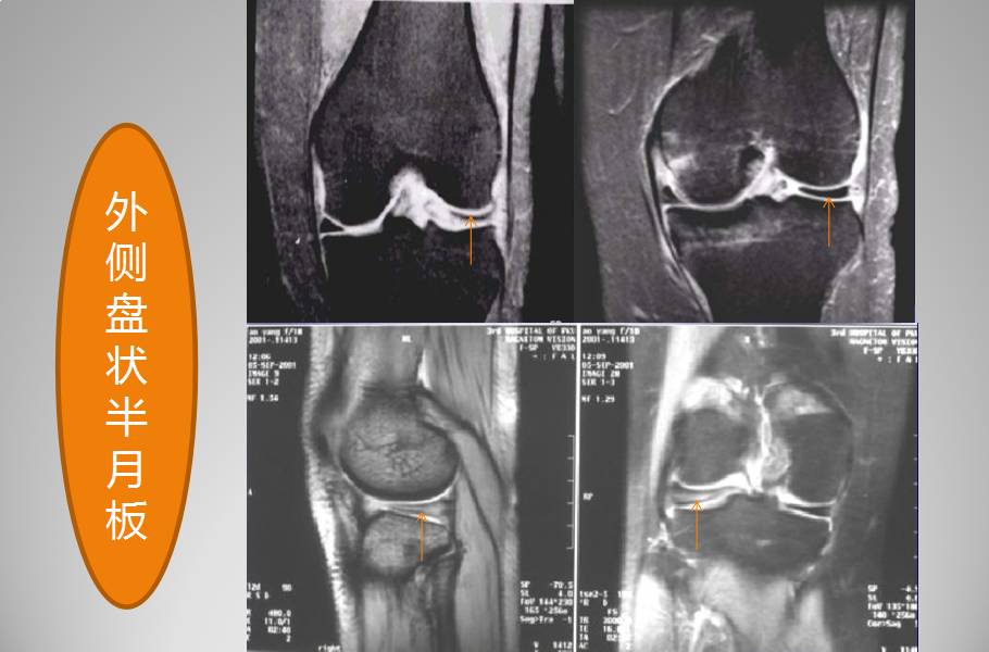 膝关节损伤MR诊断的内容及技巧