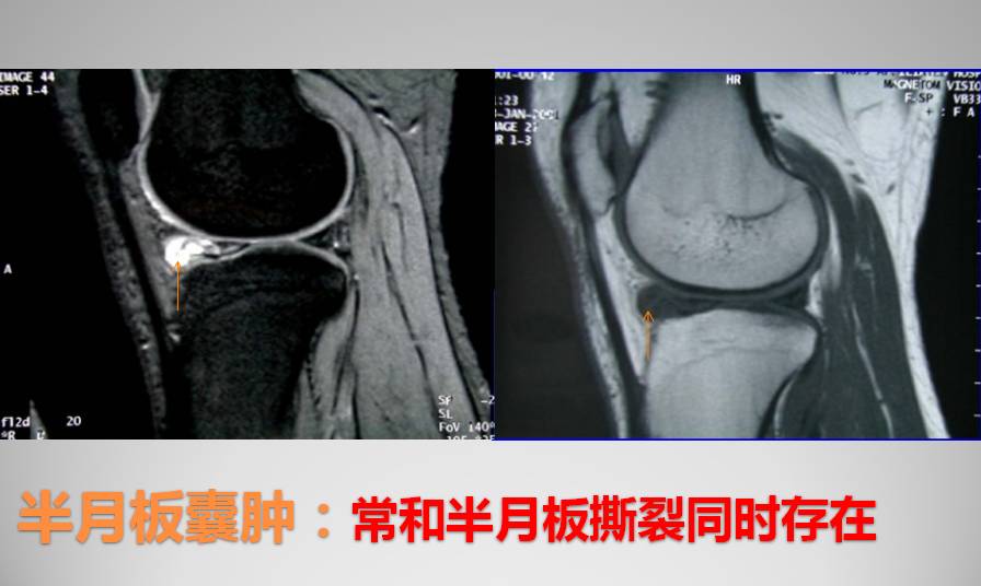 膝关节损伤MR诊断的内容及技巧