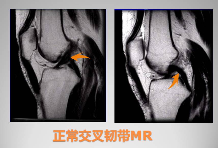 膝关节损伤MR诊断的内容及技巧