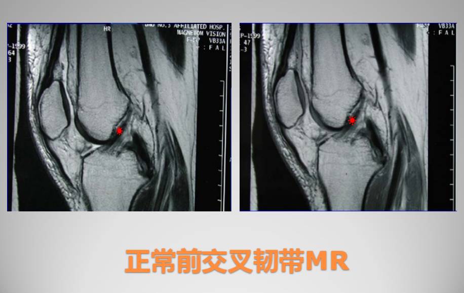 膝关节损伤MR诊断的内容及技巧