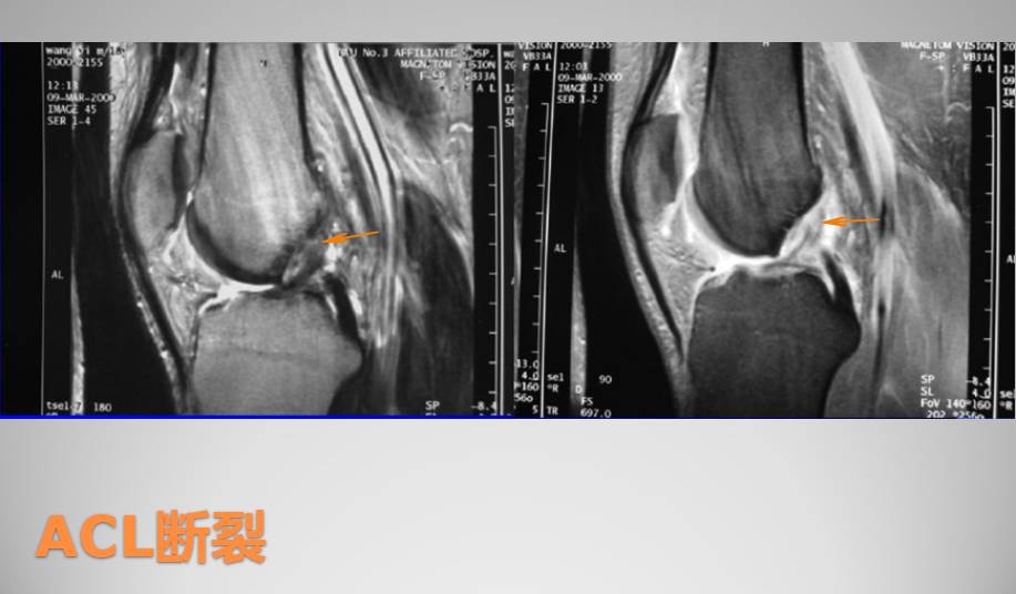 膝关节损伤MR诊断的内容及技巧