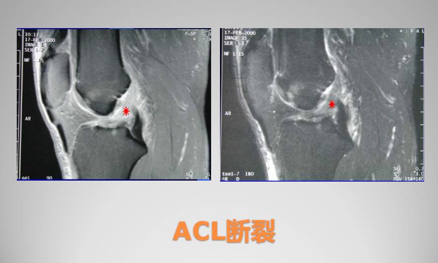 膝关节损伤MR诊断的内容及技巧