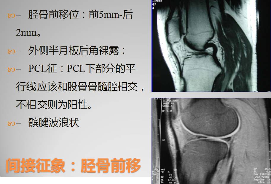 膝关节损伤MR诊断的内容及技巧