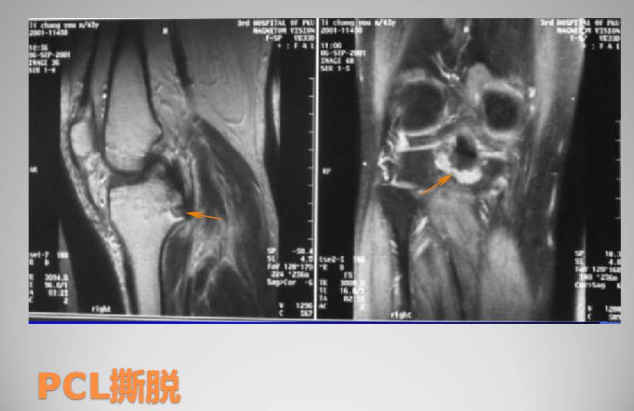 膝关节损伤MR诊断的内容及技巧