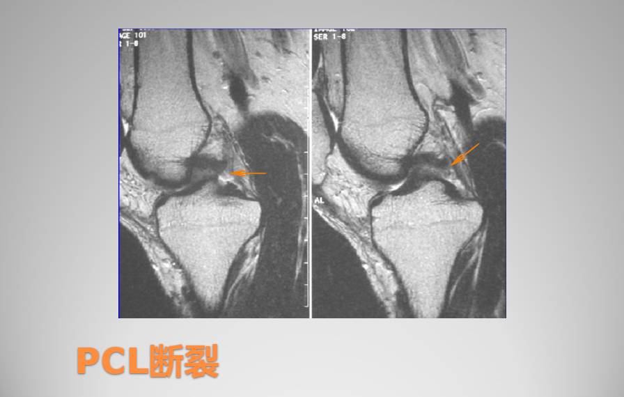 膝关节损伤MR诊断的内容及技巧