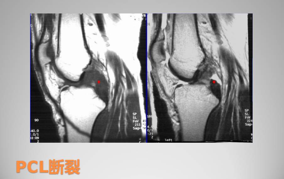 膝关节损伤MR诊断的内容及技巧