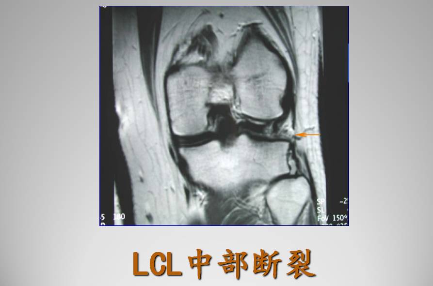 膝关节损伤MR诊断的内容及技巧