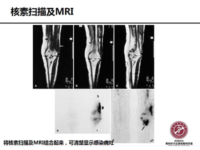 骨搬运技术在感染性骨不连中的应用