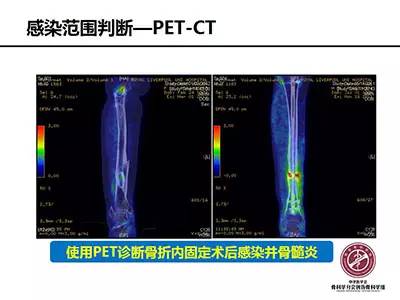 骨搬运技术在感染性骨不连中的应用