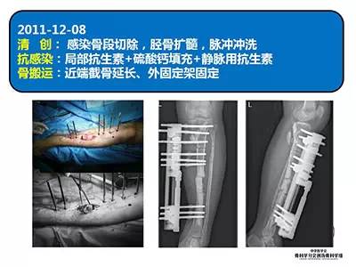 骨搬运技术在感染性骨不连中的应用