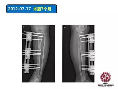 骨搬运技术在感染性骨不连中的应用