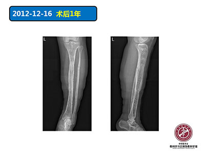 骨搬运技术在感染性骨不连中的应用