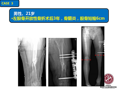 骨搬运技术在感染性骨不连中的应用