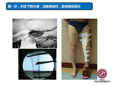 骨搬运技术在感染性骨不连中的应用