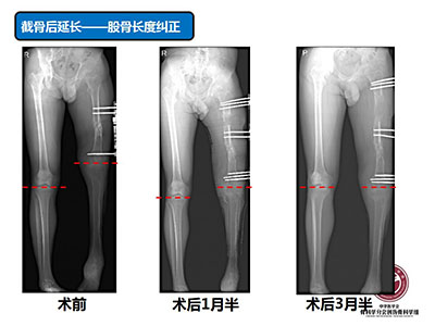 骨搬运技术在感染性骨不连中的应用