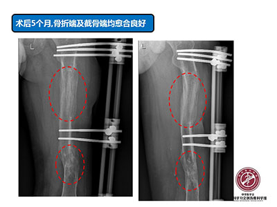 骨搬运技术在感染性骨不连中的应用