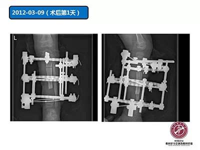 骨搬运技术在感染性骨不连中的应用