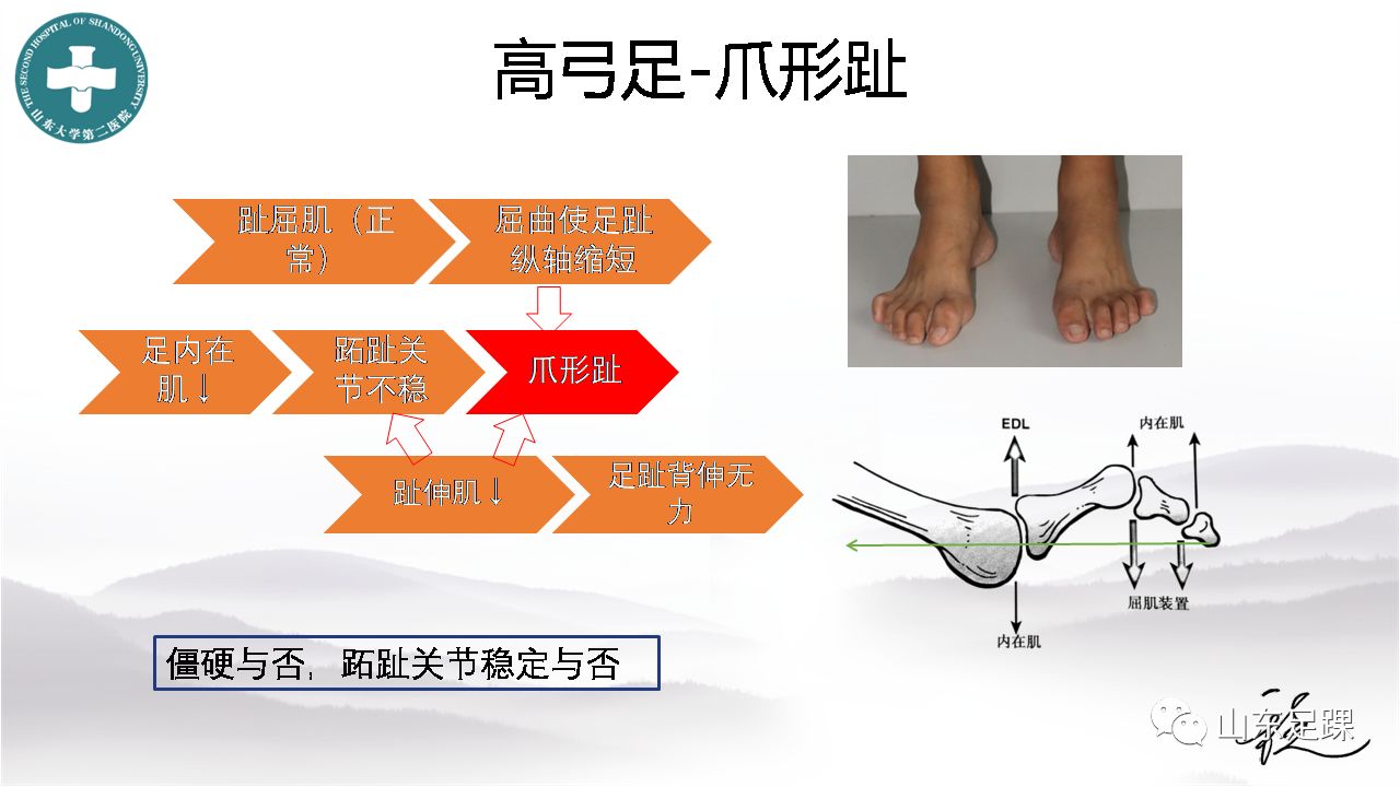 高弓足的基本病理特点及诊疗策略