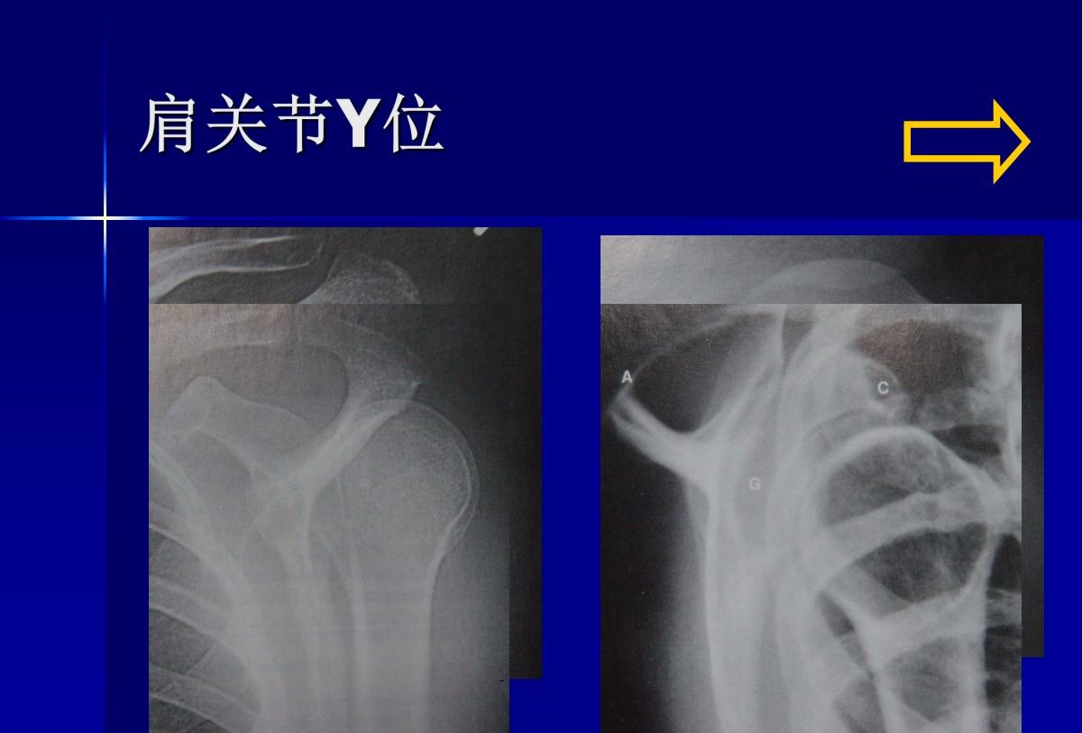 史上最全肩部体格检查汇总