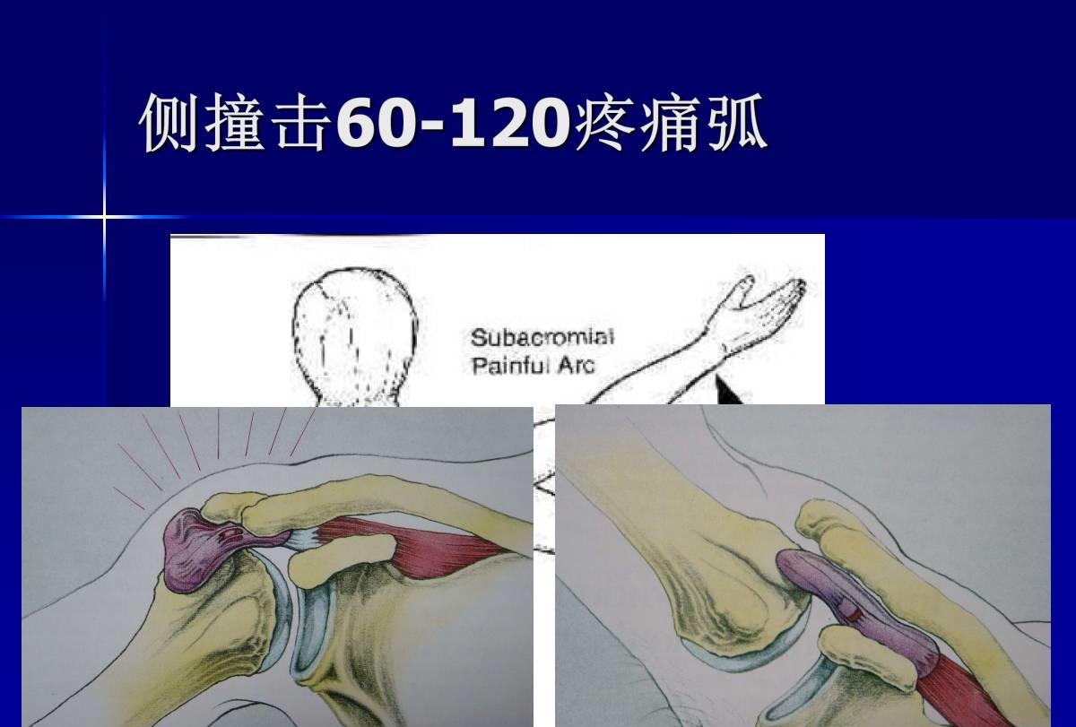 史上最全肩部体格检查汇总