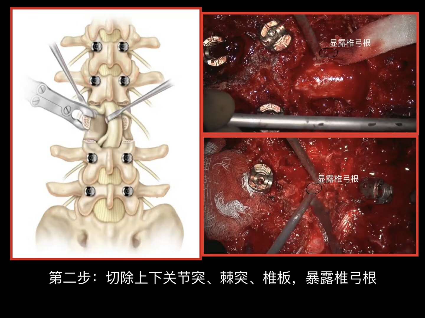 脊柱畸形PSO截骨技术步骤详解