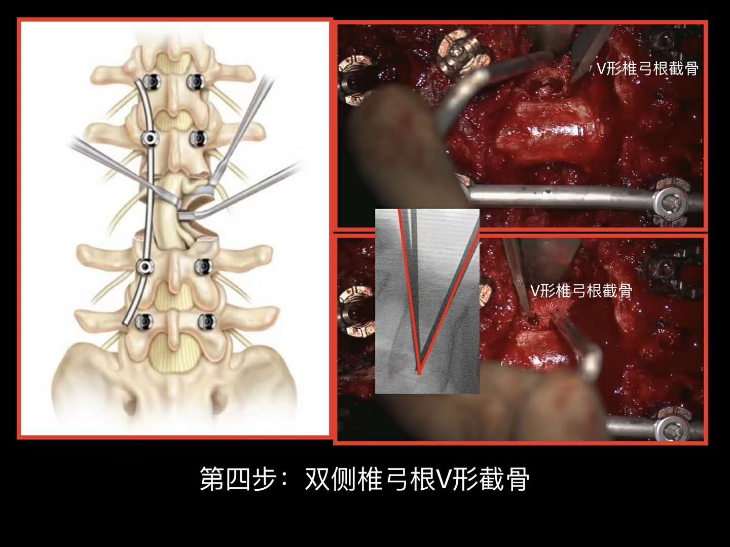 脊柱畸形PSO截骨技术步骤详解