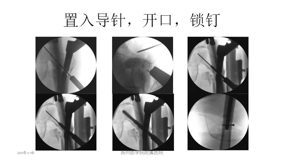 股骨转子间骨折的复位难点及对策