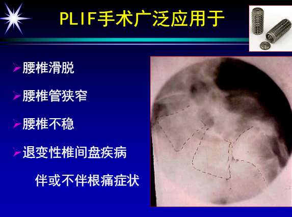 腰椎PLIF手术的并发症及其防治