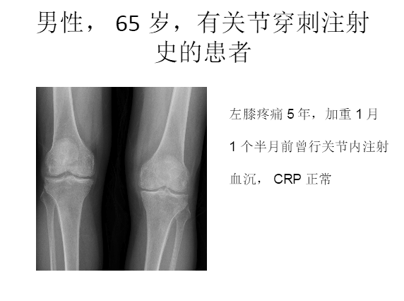 膝关节置换术后感染的防治方法