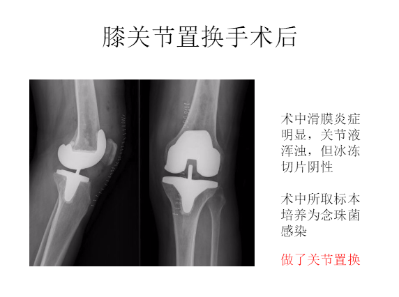 膝关节置换术后感染的防治方法