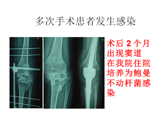 膝关节置换术后感染的防治方法