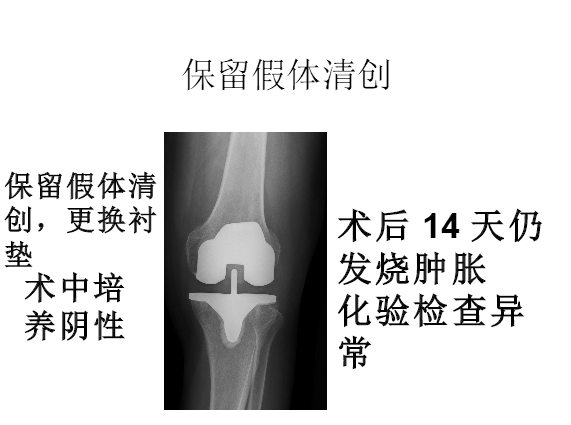 膝关节置换术后感染的防治方法