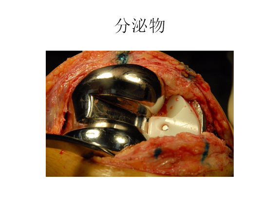 膝关节置换术后感染的防治方法