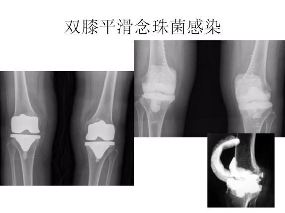 膝关节置换术后感染的防治方法