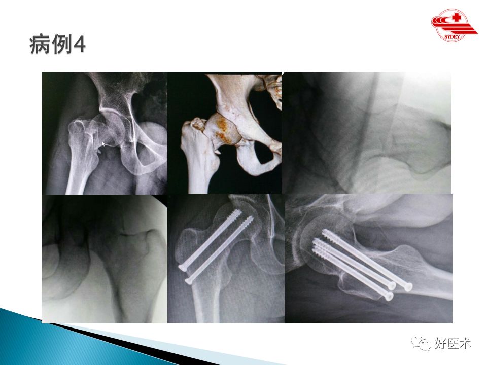 股骨颈骨折手术治疗的要点及技巧