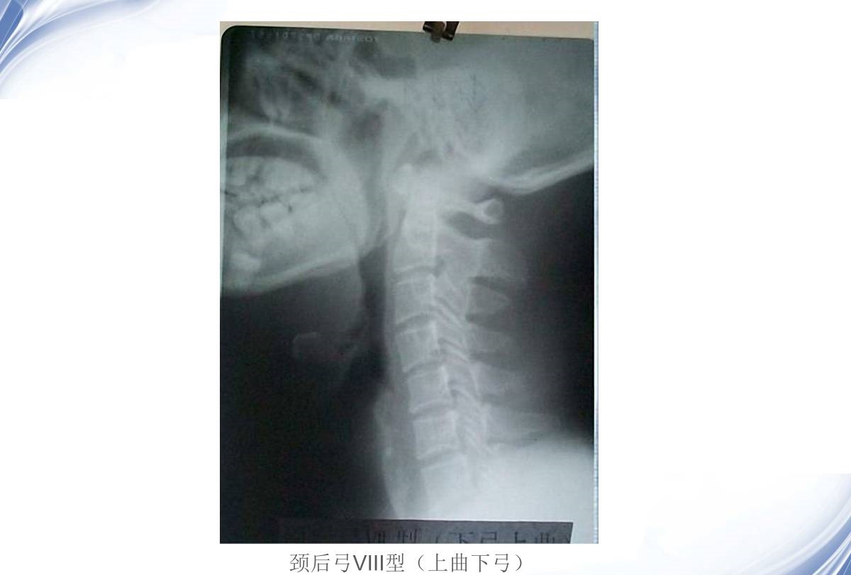 颈椎X线诊断的内容及其解读