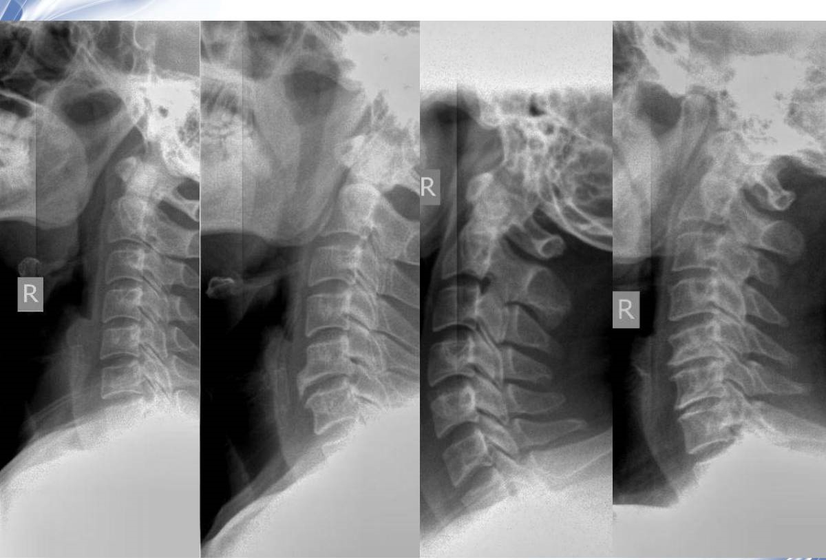 颈椎X线诊断的内容及其解读
