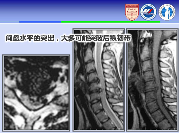 颈椎前路手术的入路解剖与临床应用