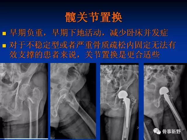 股骨粗隆间骨折的分型及常规治疗