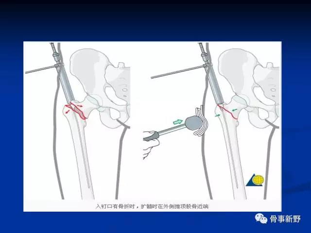 股骨粗隆间骨折的分型及常规治疗